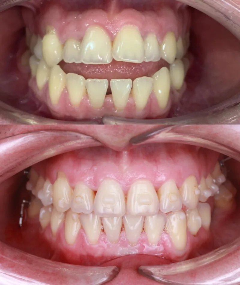 Antes y después Invisalign: Mordida abierta. Pablo, 36 años