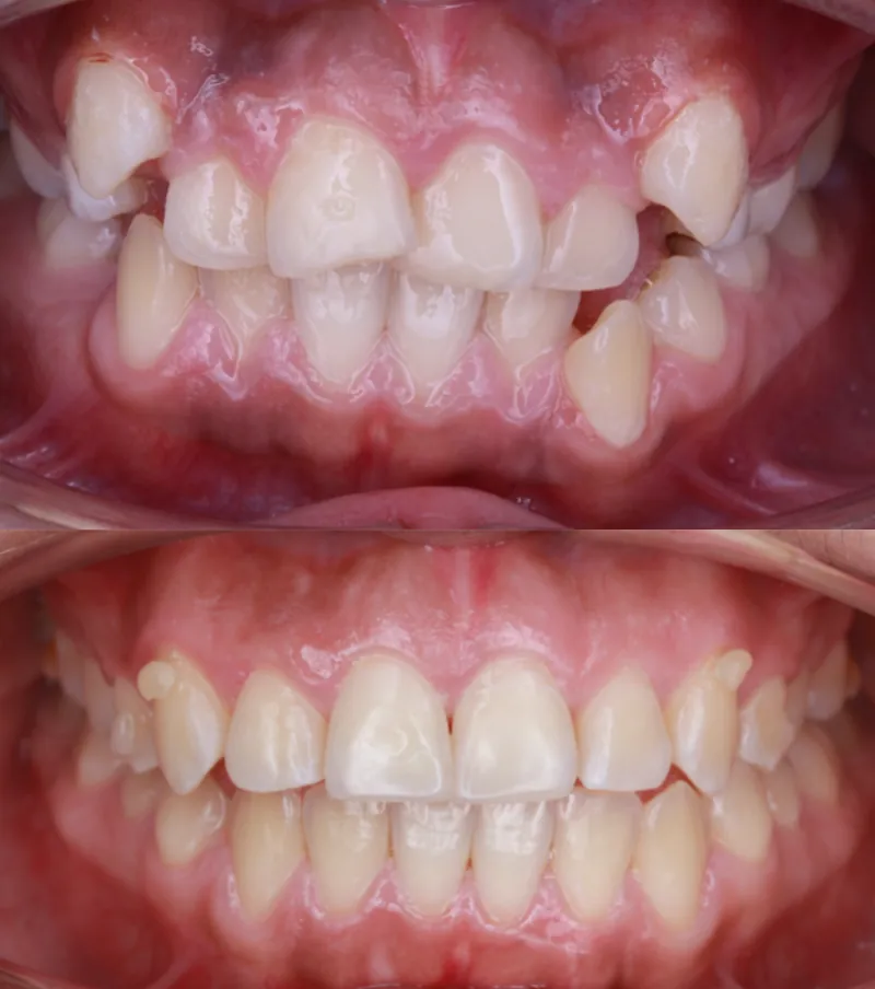 Antes y después Invisalign: Apiñamiento severo. Valeria, 15 años