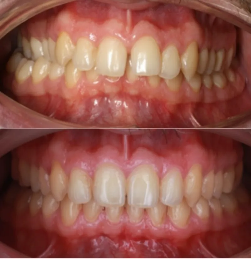Antes y después Invisalign: Mordida cruzada y cubierta. Jorge, 34 años