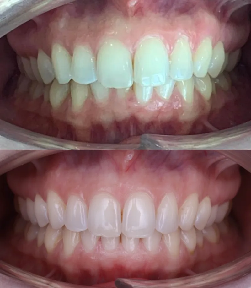 Antes y después Invisalign: Apiñamiento de dientes inferiores. Carla, 35 años