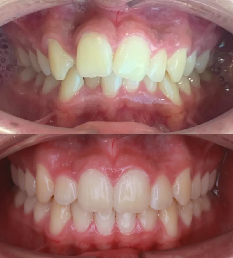 Antes y después Invisalign: Apiñamiento severo. Matías, 18 años