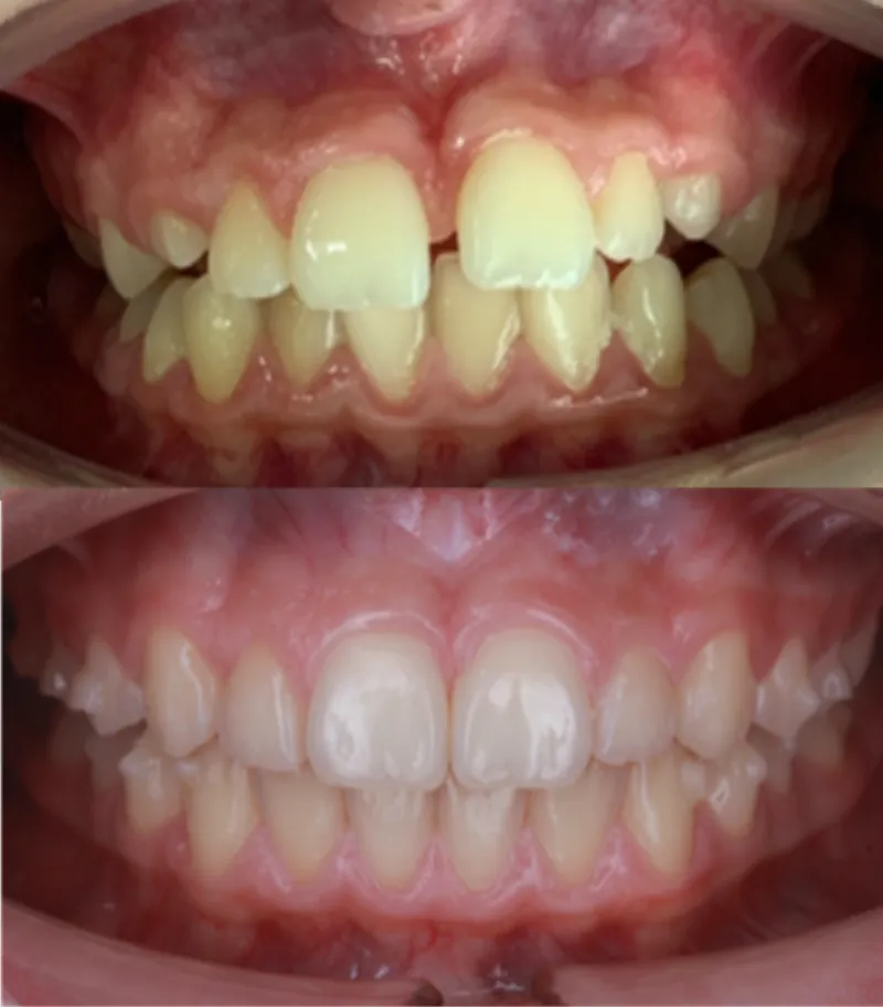 Antes y después Invisalign: Separación severa de dientes. Antonia, 15 años