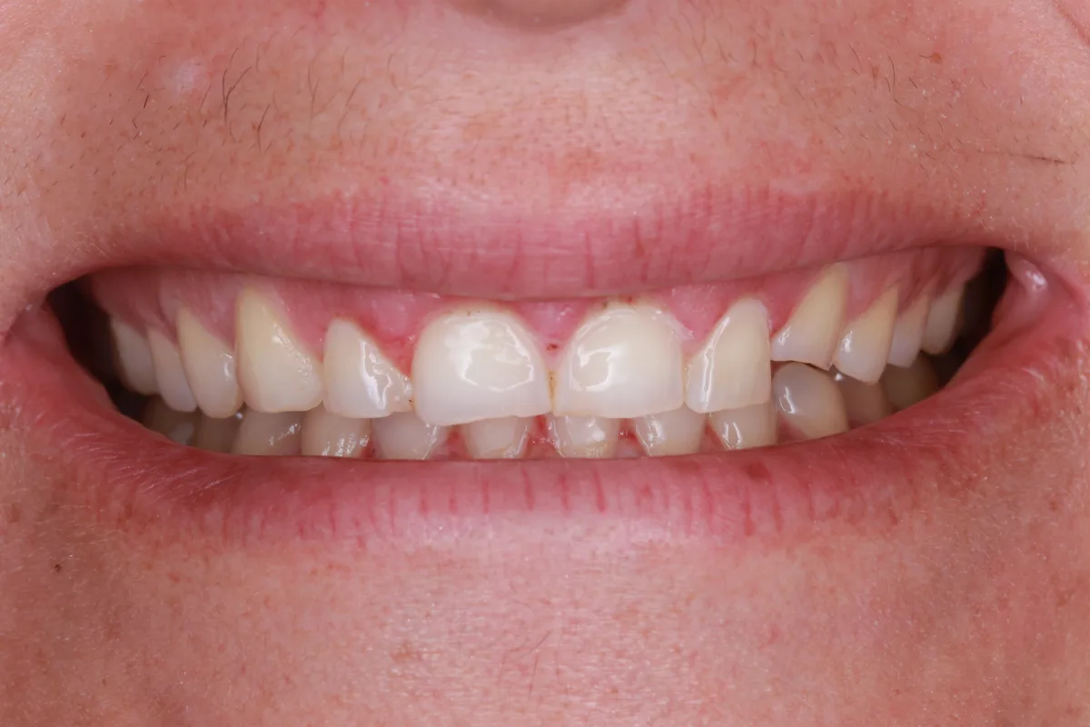 Diseño de Sonrisa, Carillas y Coronas — antes