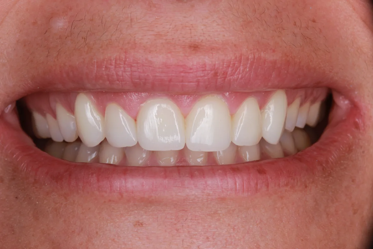 Diseño de Sonrisa, Carillas y Coronas — después